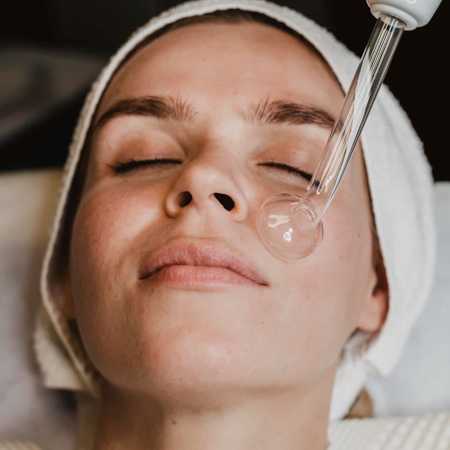 Chemical Peel for Acne